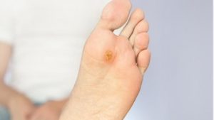 Verrugas plantares que son