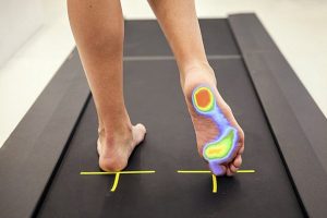 Cuándo debes realizarte un estudio de la pisada